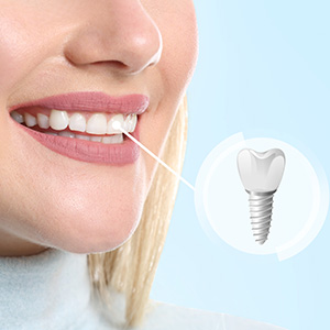 An image of a smiling woman with a tooth implant, showcasing the dental implant process.