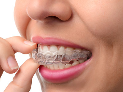 The image shows a person wearing clear aligners, which are commonly used in orthodontic treatments to straighten teeth.