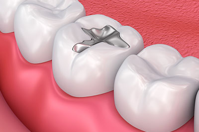 The image shows a close-up of a dental implant integrated into the upper left side of a person s teeth, with a focus on the surgical fixture.