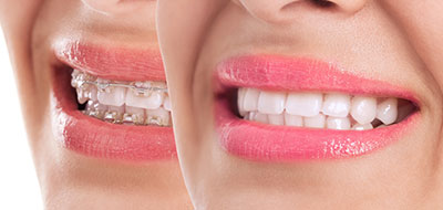 Woman with open mouth, showcasing teeth and lips, against a white background.