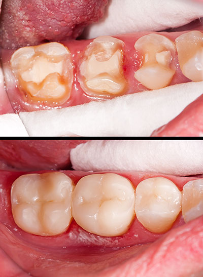 An image showing a close-up of a person s mouth with teeth and gums, highlighting dental issues such as decay and gum disease.