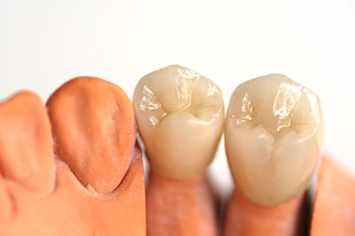 The image displays a set of artificial teeth, possibly for dental implants or a similar purpose, with one tooth showing the crown and another showing the root structure.