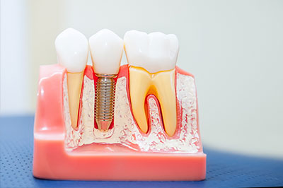 The image shows a model of a human mouth with artificial teeth, some of which have screws in them, likely to simulate the dental implant process.