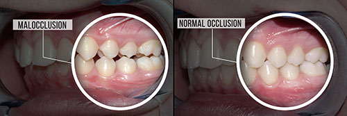 The image shows a side-by-side comparison of two teeth with annotations pointing to the differences between them, highlighting a tooth with malocclusion and another with normal occlusion.