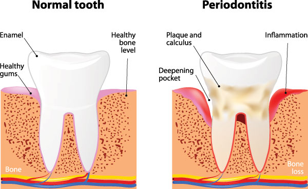 An educational graphic illustrating the progression of gum disease from normal to periodontitis, highlighting the stages and effects on teeth and bone density.