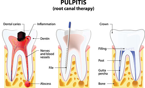 The image is a detailed medical illustration showing the structure of a tooth, including its root canal therapy and pulpitis.