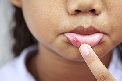 The image shows a close-up of a person s face with acne, and their hand is touching the skin around one of the blemishes.