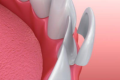 The image shows a close-up of a dental implant with a curved, metallic screw.