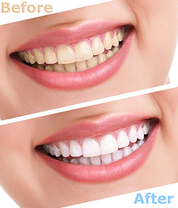 Before and after teeth whitening results displayed on a website.