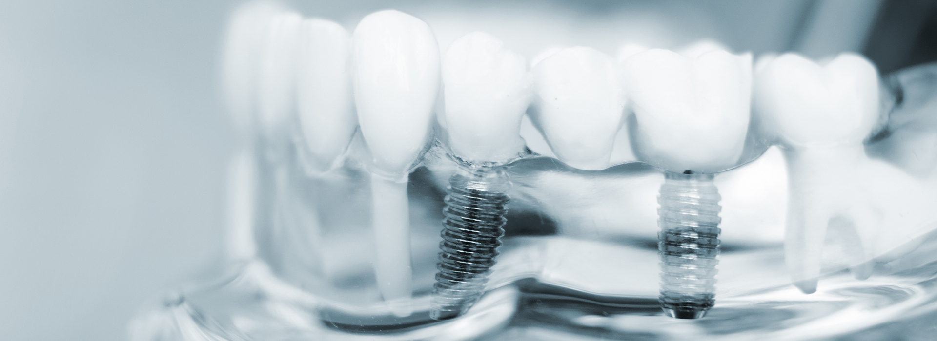 The image displays a close-up view of a dental implant with screws and an abutment, showcasing the components used in dental prosthetics.