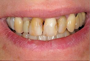 Image of a person s mouth with yellow teeth, showcasing dental decay and staining.